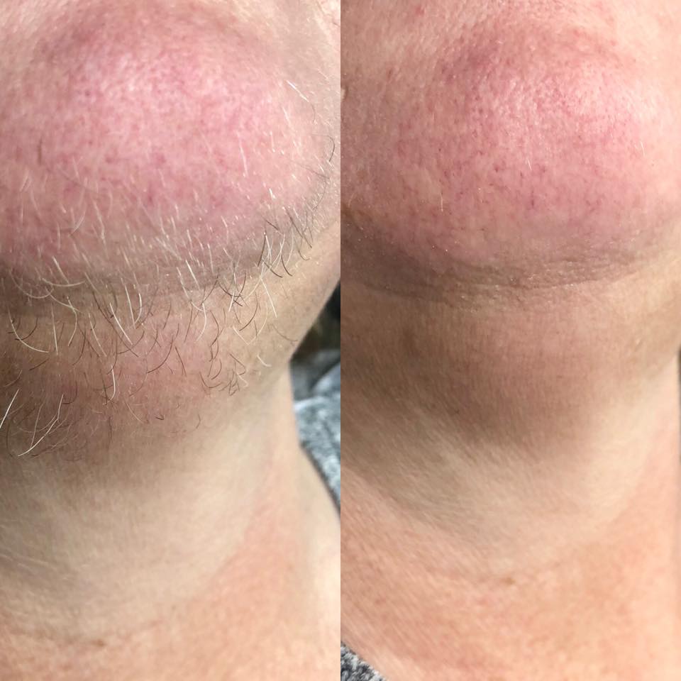 Óæskilegur hárvöxtur, mismunandi aðferðir að fjarlægja hár.